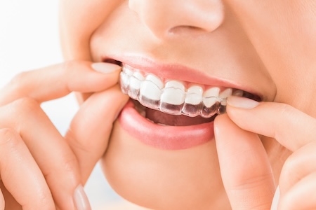 clear aligners